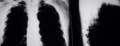 Lung xray