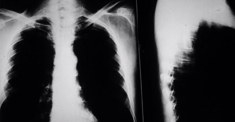 Lung xray