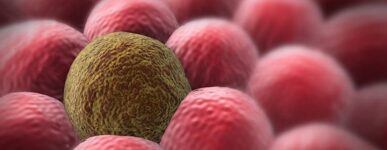 Sarcomatoid Mesothelioma, a Deadly Cancer of the Lungs