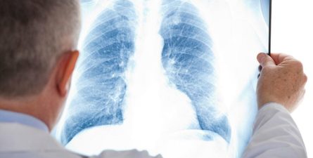 Lung Cancer and Mesothelioma Hide from Early Detection