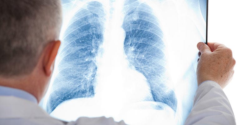 Lung Cancer and Mesothelioma Hide from Early Detection