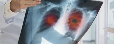 Lung Cancer vs. Mesothelioma: The Facts on Survival Rates