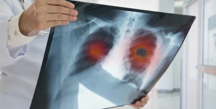 Lung Cancer vs. Mesothelioma: The Facts on Survival Rates