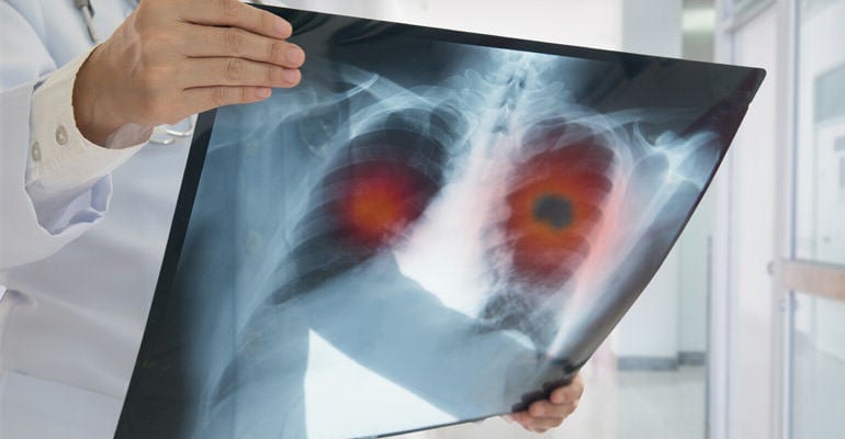 Lung Cancer vs. Mesothelioma: The Facts on Survival Rates