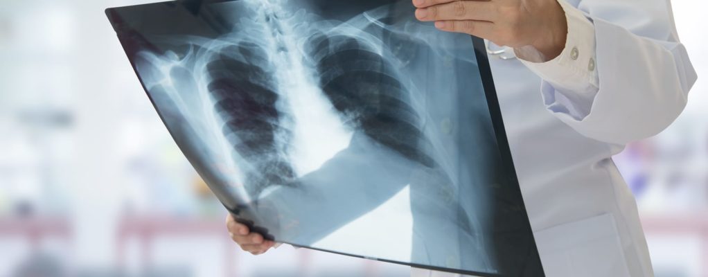 Doctor holding lung xray