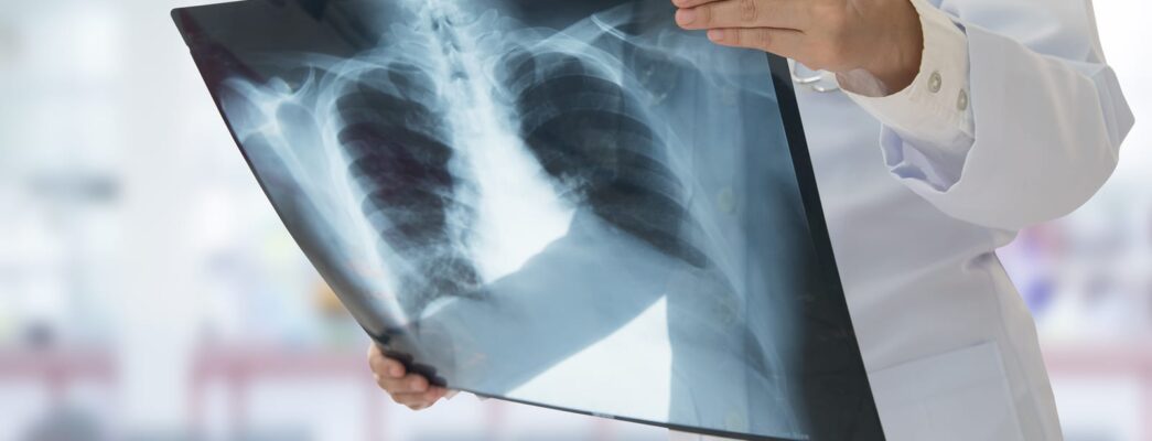 Doctor holding lung xray