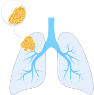 Stage 2 Mesothelioma