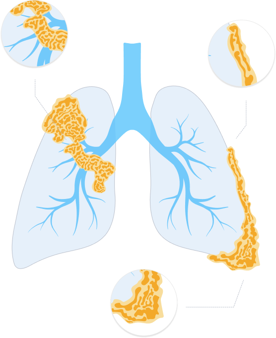 can you see asbestos on an x ray