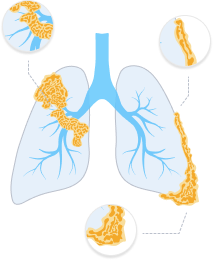 Stage 4 Mesothelioma