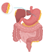 Illustration of peritoneal mesothelioma cancer in the abdominal lining affecting a patient's left side
