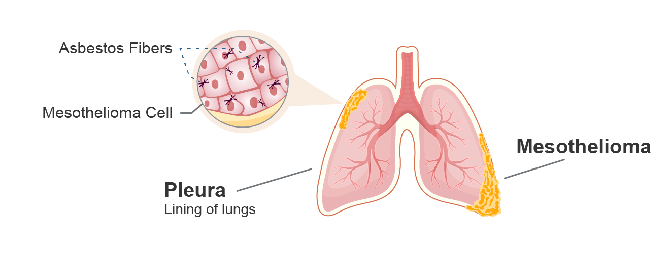 Illustration of pleural mesothelioma cancer in the lining of the lungs (also known as the pleura)