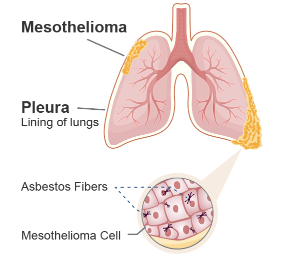 Illustration of pleural mesothelioma cancer in the lining of a patient's right lung