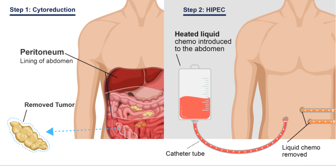 An illustration of the two steps involved in cytoreduction with HIPEC: Surgical removal of tumors in the lining of the abdomen (peritoneum) followed by heated chemotherapy liquid introduced into the abdomen through a catheter tube. The liquid chemo therapy solution is then drained from the abdomen.