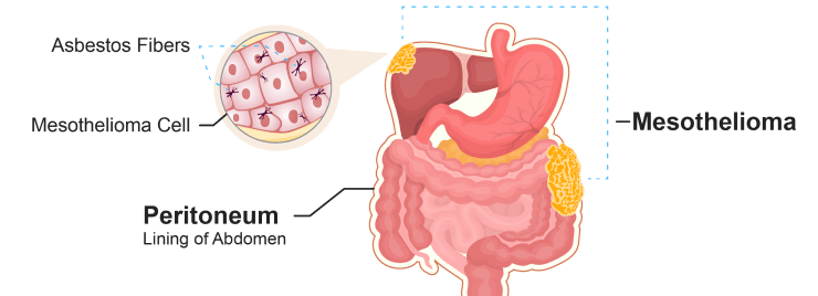 An illustration shows mesothelioma in the lining of the abdomen (also known as the peritoneum)