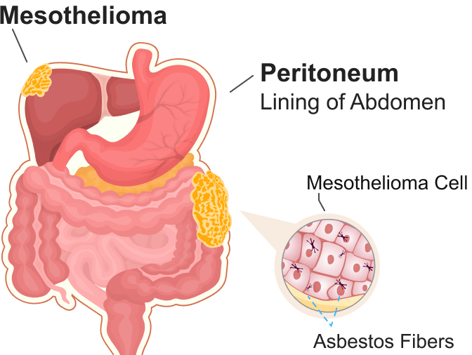 Illustration of peritoneal mesothelioma cancer in the abdominal lining affecting a patient's left side