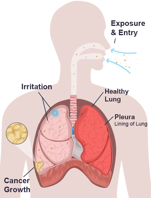 An illustration of how asbestos fibers enter the lungs, cause irritation, and lead to cancer growth in the lining of the lung (pleura)