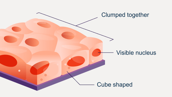 Illustration showing characteristics of epithelial mesothelioma cells: cube shaped, clumped together, and a visible nucleus