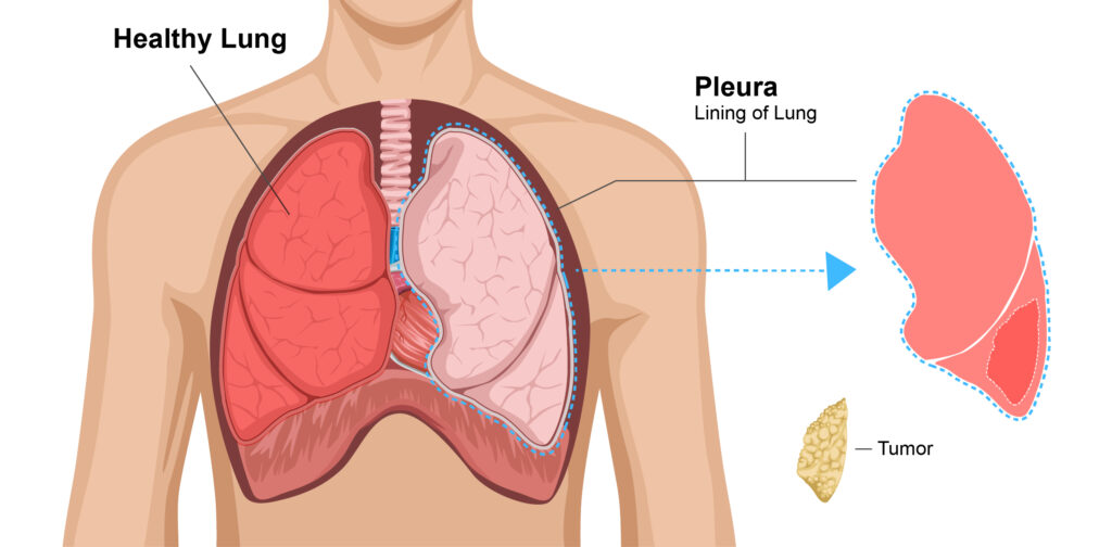 Illustration showing the lung lining being removed in a pleurectomy
