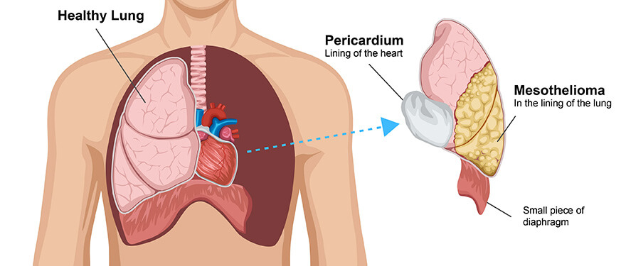 Illustration of a person's chest cavity, showing mesothelioma forming in the lining of the lung