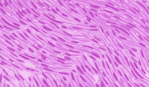 Illustration of sarcomatoid cells under a microscope