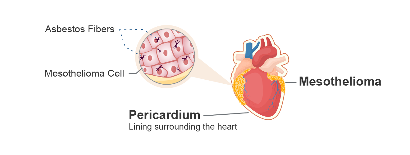 An illustration shows how pericardial mesothelioma forms on the protective sac-like lining of the heart known as the pericardium