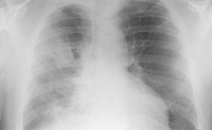 A chest x-ray shows pleural plaques