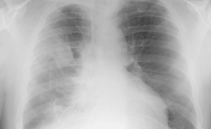 A chest X-ray shows pleural plaques