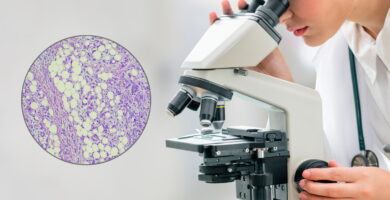 Doctor looks in microscope for mesothelioma cell type