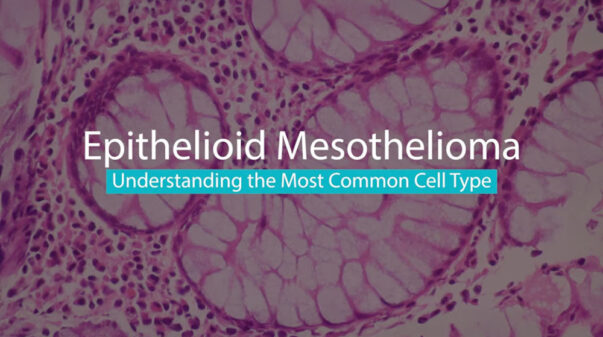 Epithelioid Mesothelioma Video Thumbnail