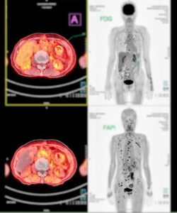 PET scan of the entire body highighting areas of potential cancer 
