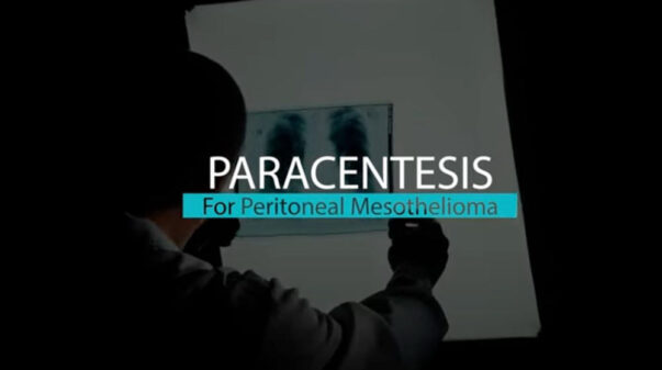 Paracentesis for Peritoneal Mesothelioma | Mesothelioma Hope Video Thumbnail
