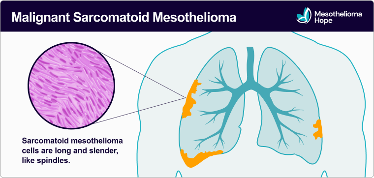 "Medical illustration of malignant sarcomatoid mesothelioma. Diagram of lungs highlights orange areas along the lung lining where tumors may form. An inset shows sarcomatoid mesothelioma cells, which appear long and slender like spindles. The image is labeled ‘Sarcomatoid mesothelioma cells are long and slender, like spindles,’ with the Mesothelioma Hope logo in the corner."