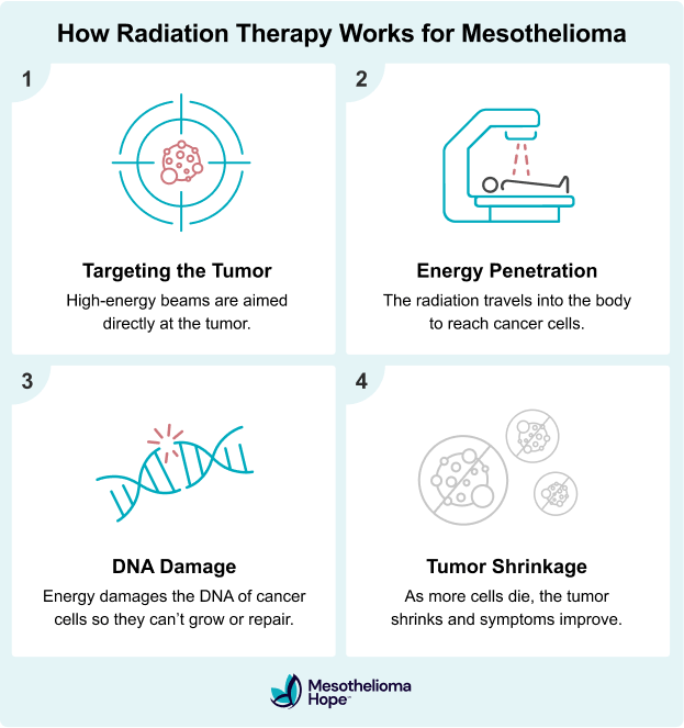 Infographic explaining how radiation therapy works for mesothelioma in four steps