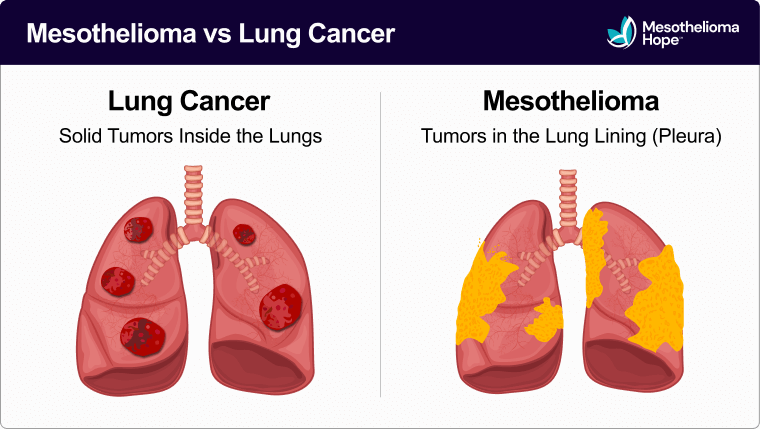 Infographic titled "Mesothelioma vs Lung Cancer." Illustration shows the difference in how tumors develop for lung cancer (as solid tumors inside the lungs) and mesothelioma (as sheet-like tumors in the lung lining).